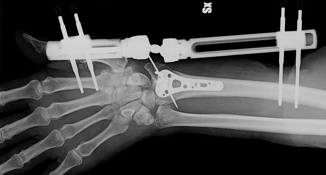Bone-02: dalla Cina la rivoluzionaria colla ossea che ripara le fratture in pochi minuti