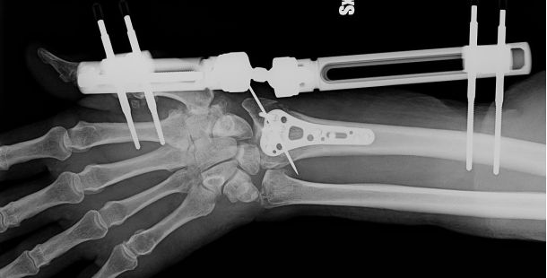 Bone-02: dalla Cina la rivoluzionaria colla ossea che ripara le fratture in pochi minuti