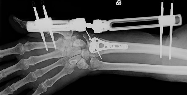 Bone-02: dalla Cina la rivoluzionaria colla ossea che ripara le fratture in pochi minuti